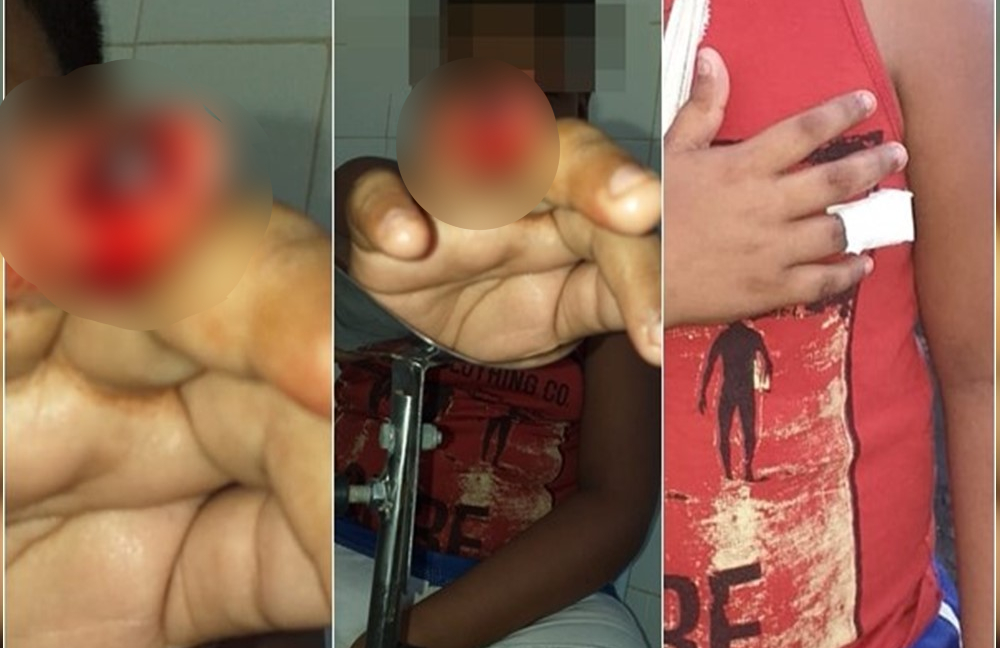 Criança perde parte de dedo durante brincadeira em escola